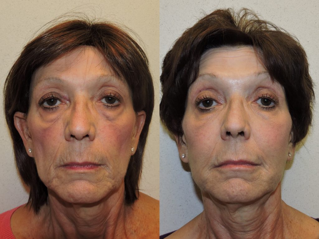 Before and after of a A 60-year-old female who was treated with Botox along with a series of fillers.