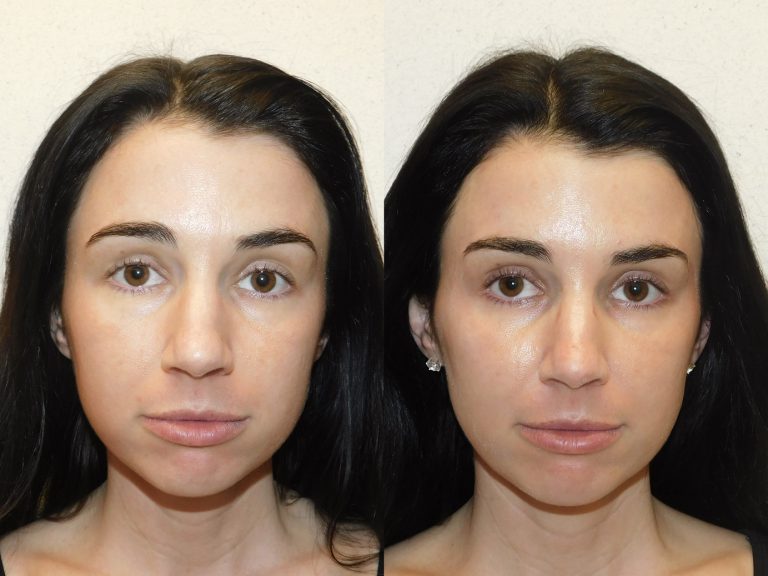 Before and after of a 29-year-old Female patient treated with Restylane Silk Filler to increase lip volume along with Dysport.