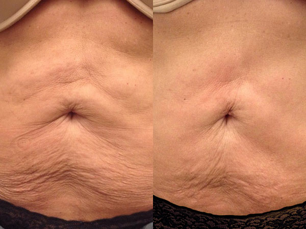 Before and after of a Female patient who was treated in LovelySkin Spa with PelleFirm to the abdomen.