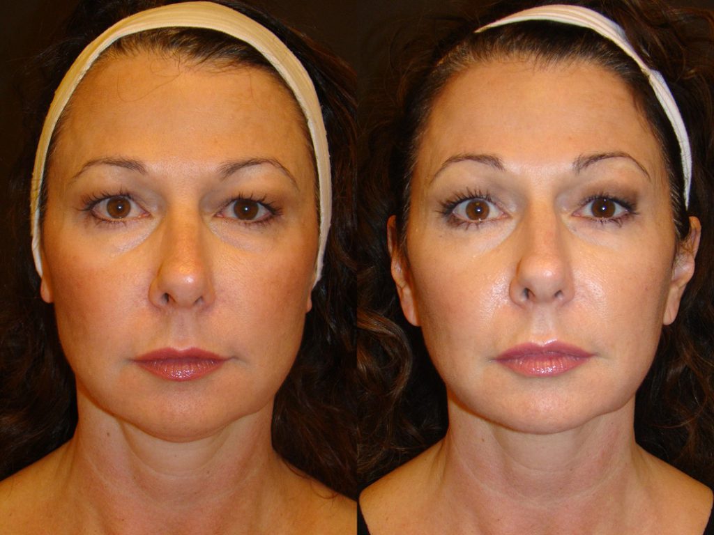 Ultherapy Before and After