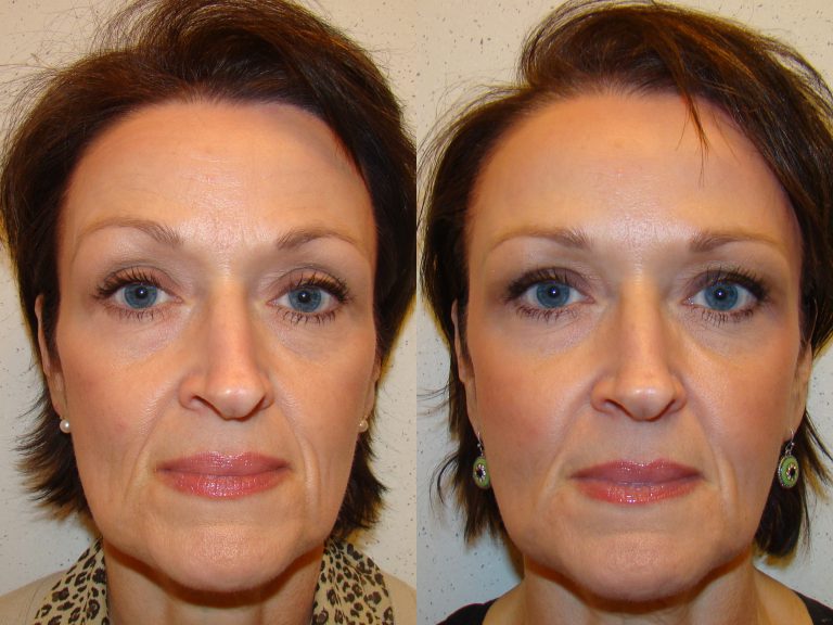 Before and after of a 54-year-old woman who had Dysport along with a series of fillers to improve volume loss.