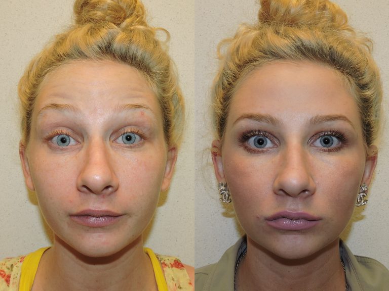 Before and after of a 26-year-old Female patient treated with Restylane Silk Filler to increase lip volume along with Dysport.