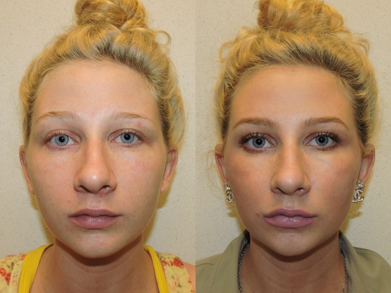 Before and after of a 26-year-old Female patient treated with Restylane Silk Filler, along with Dysport