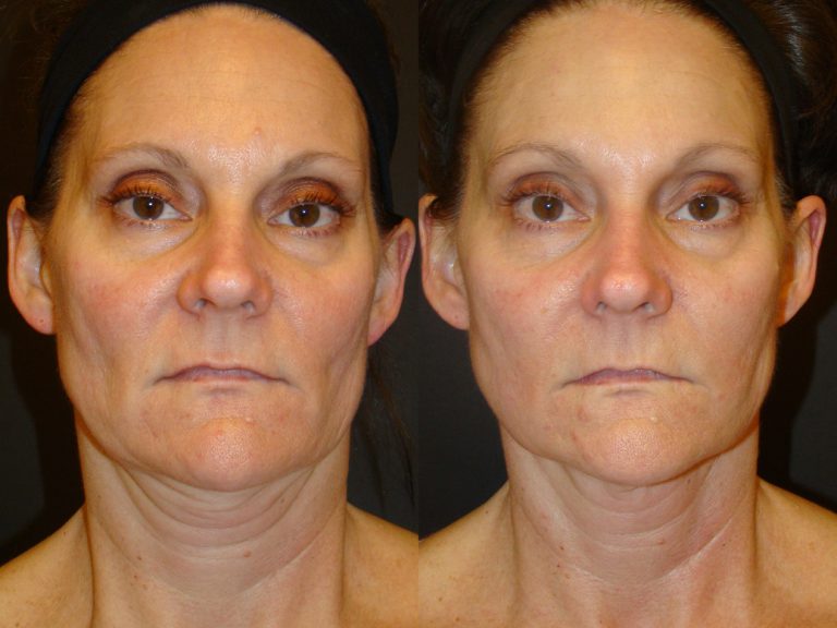 Before and after of a 50-year-old Female patient treated with Full Face Ultherapy.