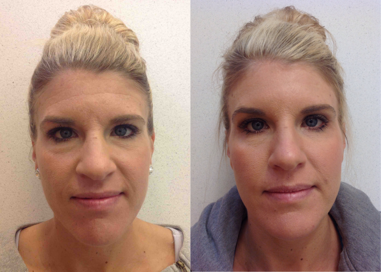 Before and after of a 38-year-old female who was treated with Botox.