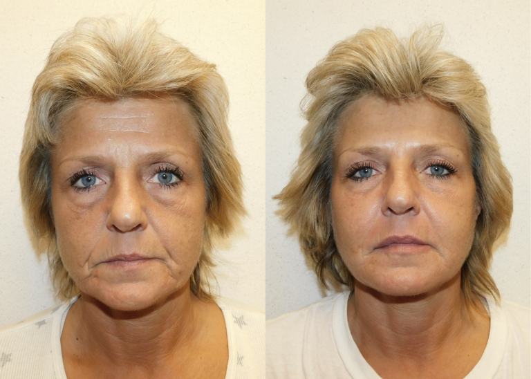 Before and after of a 53-year-old Female patient treated with Botox along with a series of Juvederm and Restylane fillers.