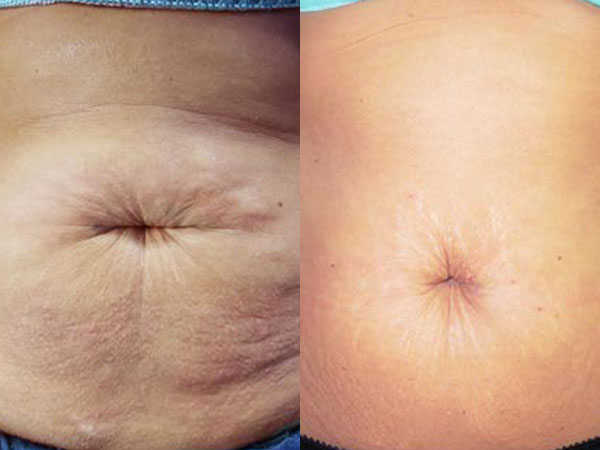 Before and after of a Female patient who was treated in LovelySkin Spa with PelleFirm to the abdomen.