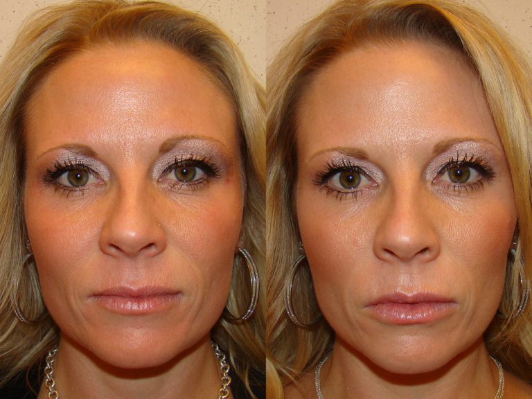 Before and after of a A 37-year-old Female patient treated with Restylane Silk Filler