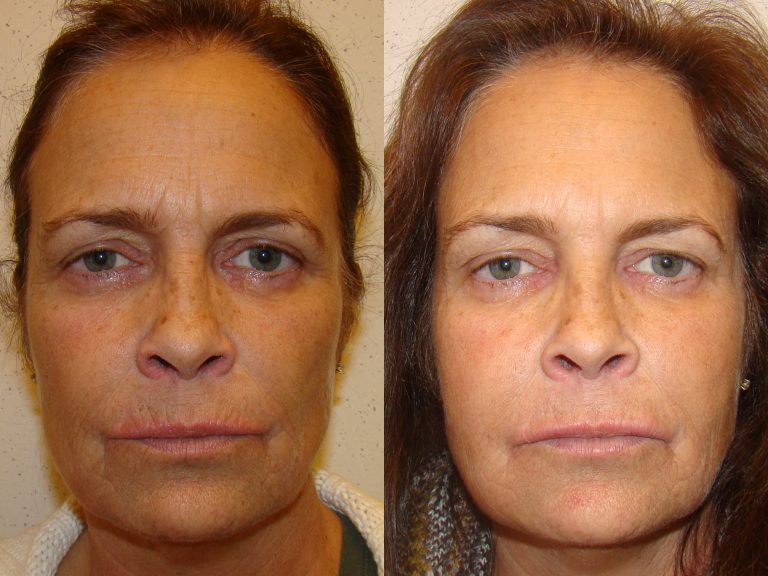 Before and after of a 54-year-old female who was treated with Botox along with a series of fillers.