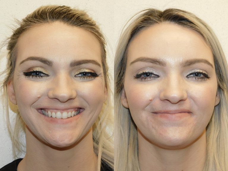 Before and after of a 36-year-old Female patient treated with Dysport.