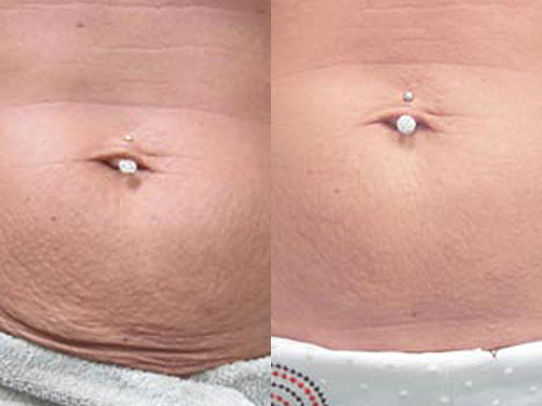 Before and after of a Female patient who was treated in LovelySkin Spa with PelleFirm to the abdomen.