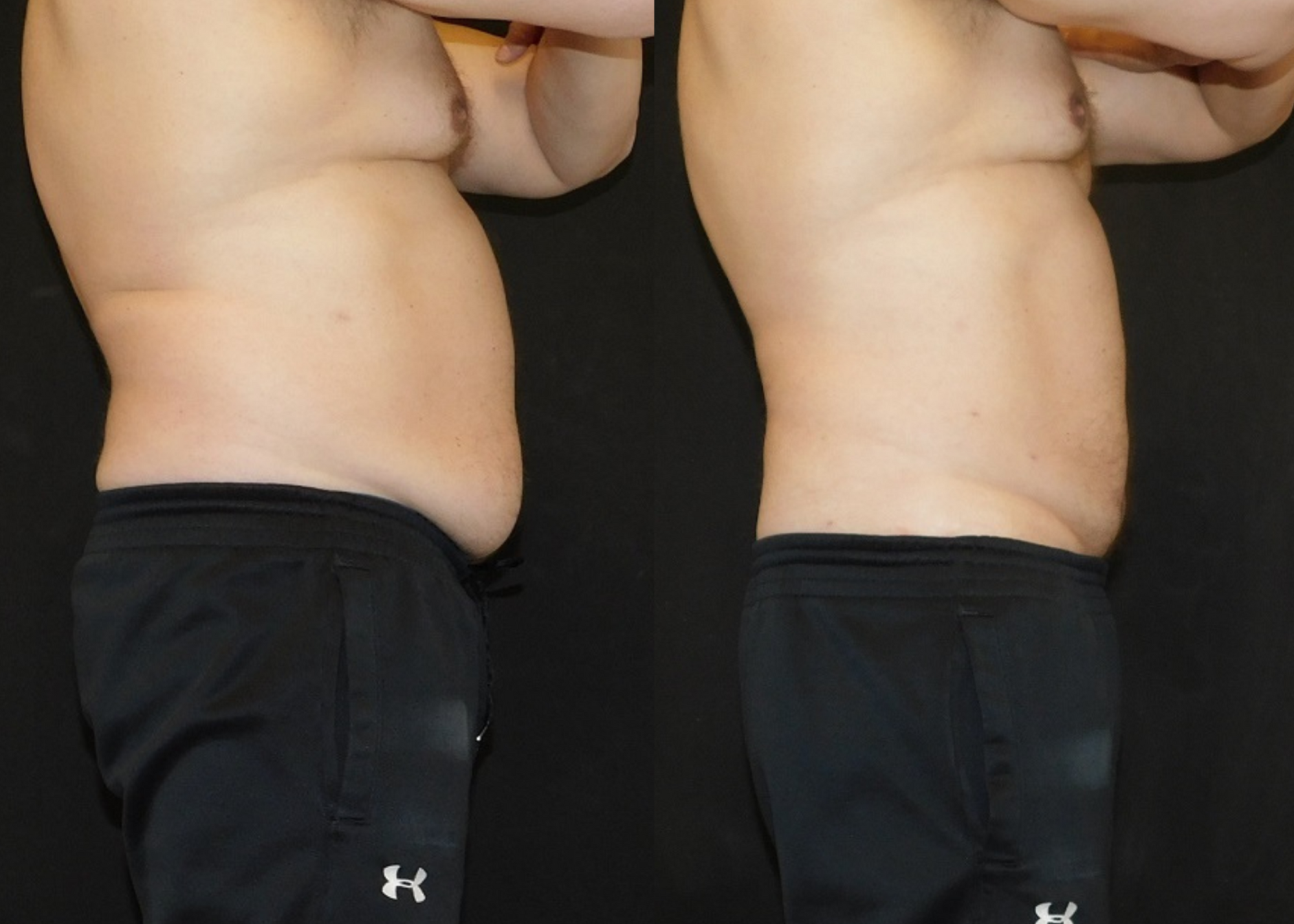 SmartLipo Abdomen Before and After