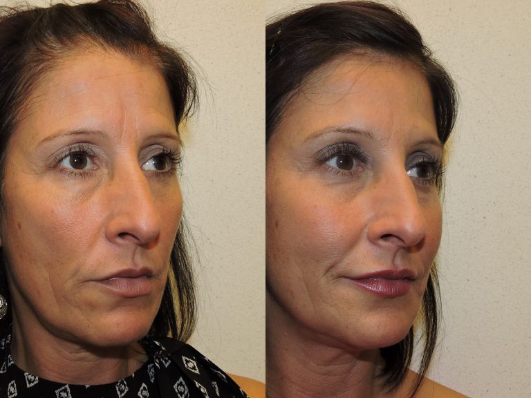 Before and after of a 49-year-old Female patient treated with Dysport along with a series of fillers.