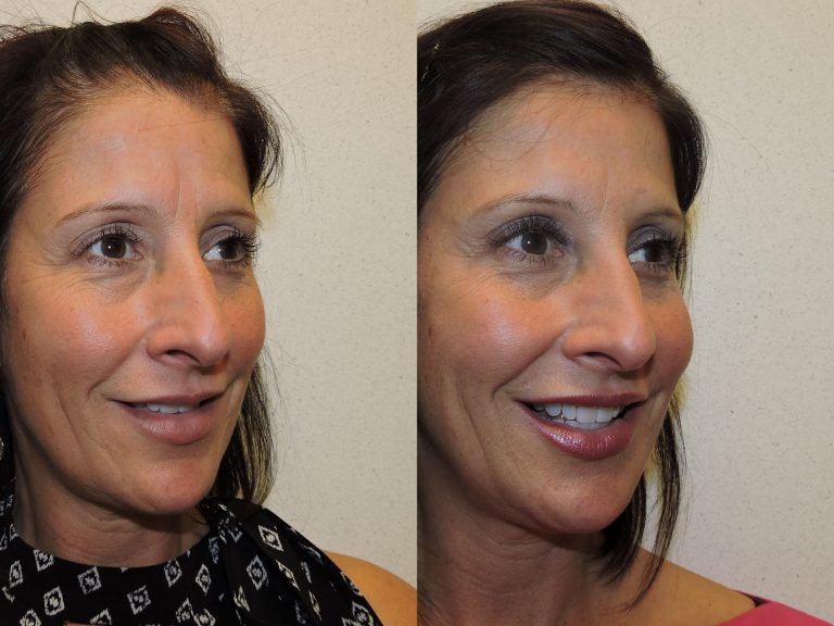 Before and after of a 49-year-old Female patient treated with Botox along with a series of fillers.