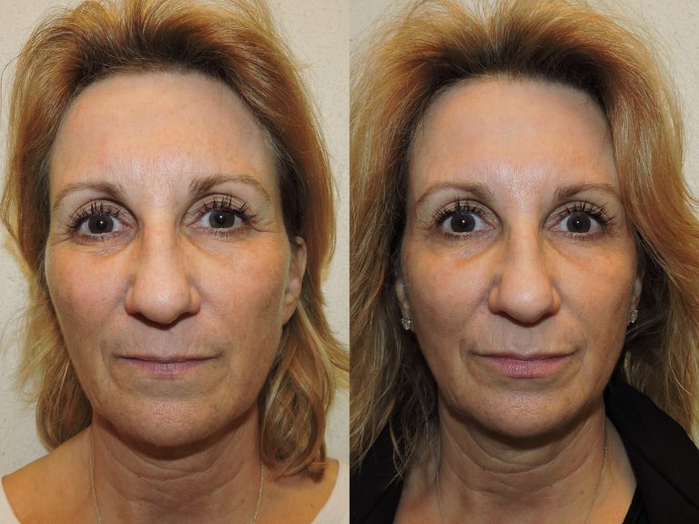 Before and after of a 58-year-old Female patient treated with Botox along with Juvederm Volbella Filler 