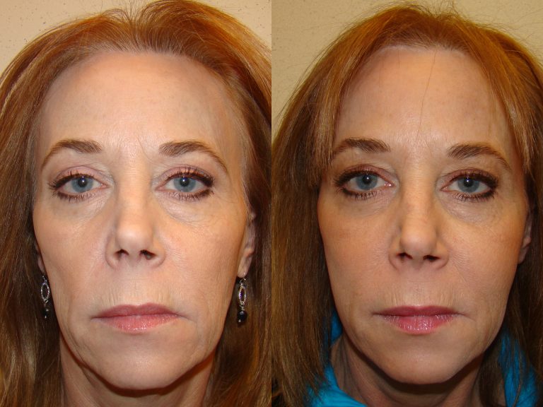 Before and after of a 60-year-old female who was treated with Botox along with a series of fillers.