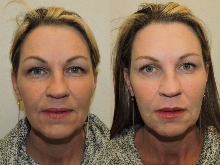 Before and after of a 48-year-old Female who had Botox along with a combination of Restylane and Juvederm Fillers 