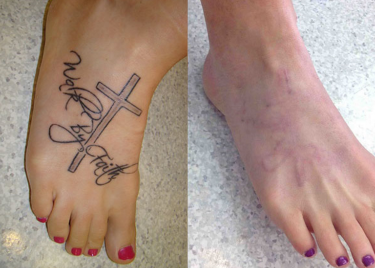 Before and after of a Female patient treated with Laser Tattoo Removal  on top of foot. 