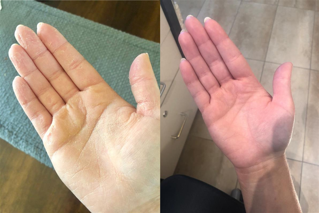 Before and after of a patient treated with the FixMySkin for 3 days of 4x daily to improve the reaction of Contact Dermatitis