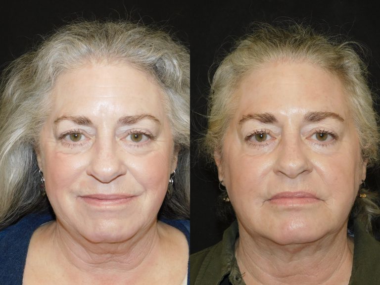 Before and after of a 64-year-old Female patient treated with Botox, Fillers, and CoolSculpting Mini