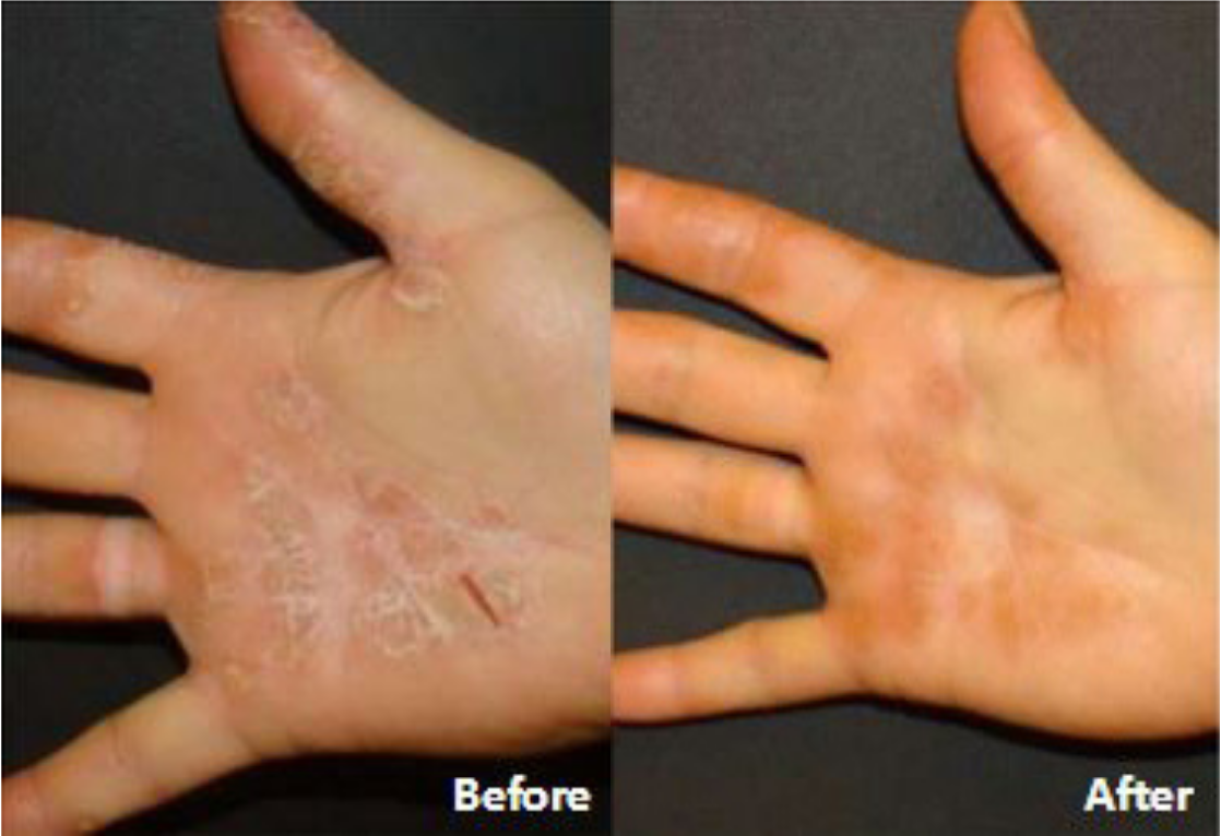 Before and after of a Female patient treated with the FixMySkin Healing Balm with 1% Hydrocortisone to improve the appearance of Eczema located on hands, results; Post One Month Use.