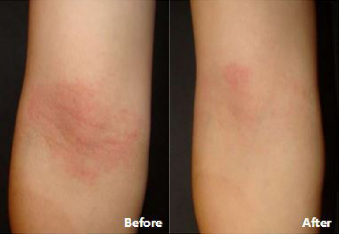 Before and after of a Female patient treated with the FixMySkin Healing Balm with 1% Hydrocortisone to improve the appearance of Eczema located on the inner elbow, results; Post One Month Use.