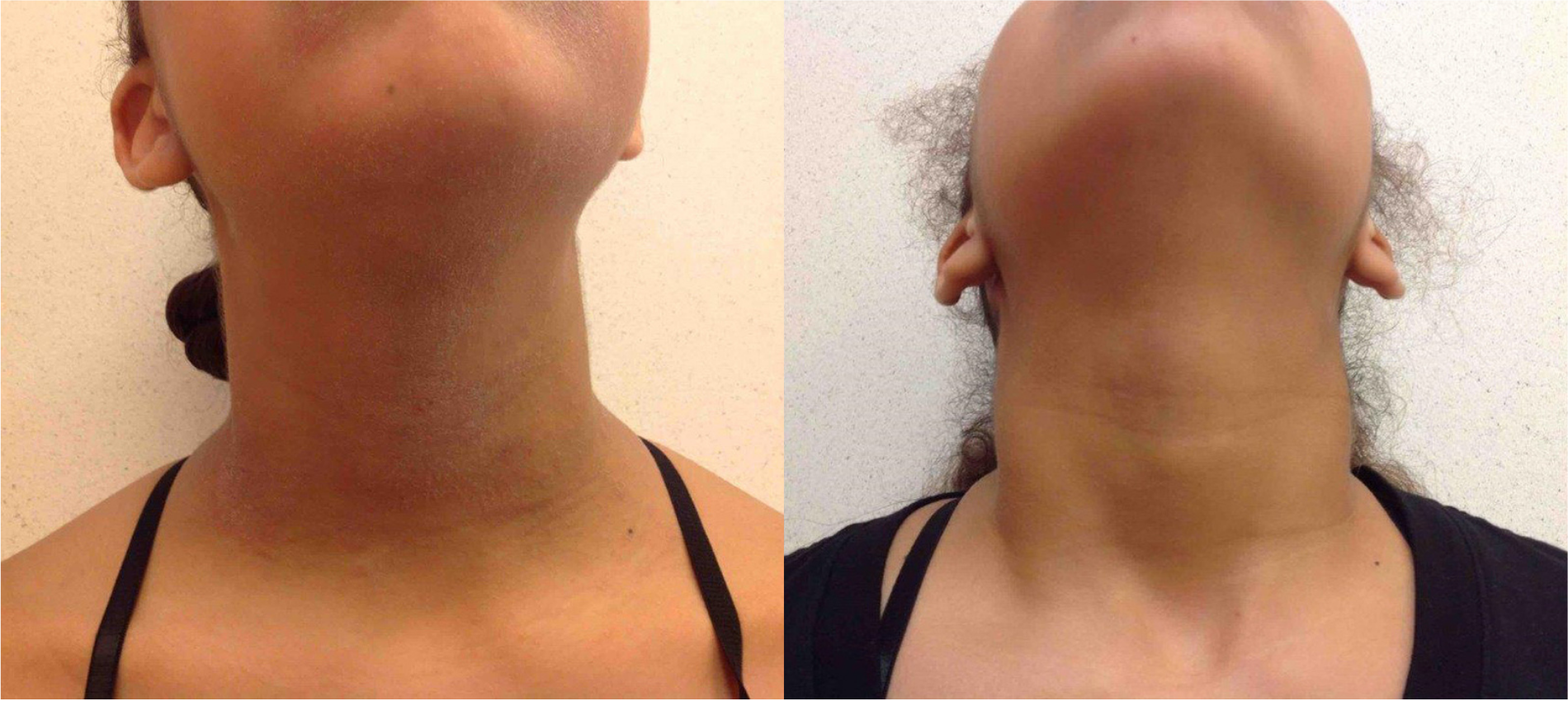 Before and after of a Female patient treated with the FixMySkin Healing Balm with 1% Hydrocortisone to improve the appearance of Eczema located on the neck, results; Post One Month Use.