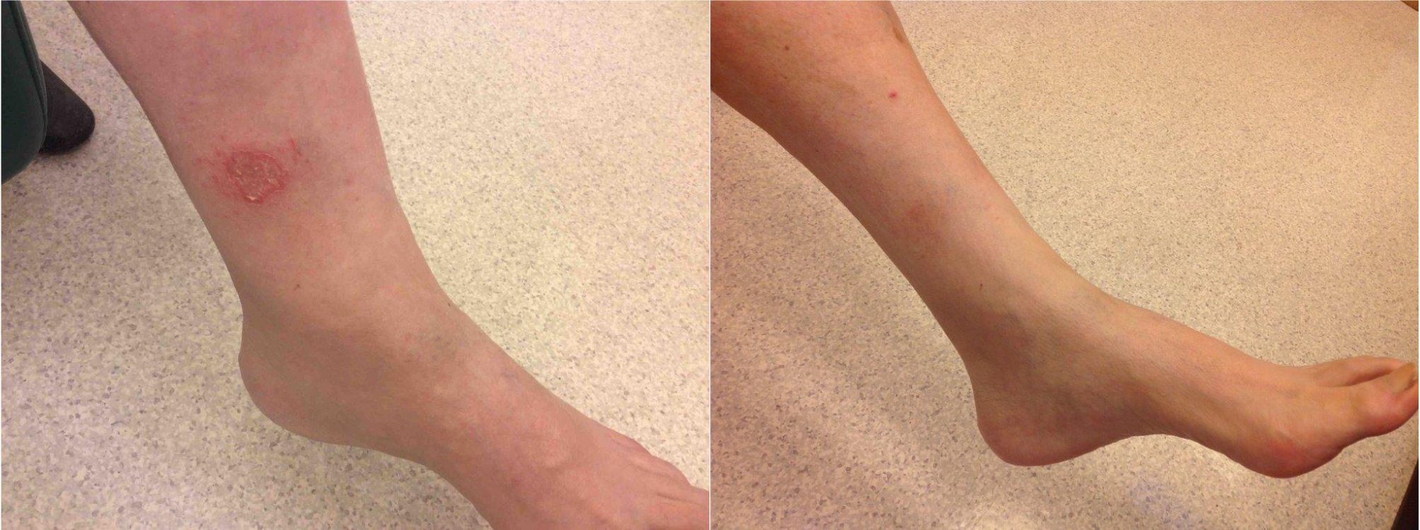 Before and after of a Male patient treated with the FixMySkin Healing Balm with 1% Hydrocortisone to improve the appearance of Eczema located on the ankle, results; Post One Month Use.