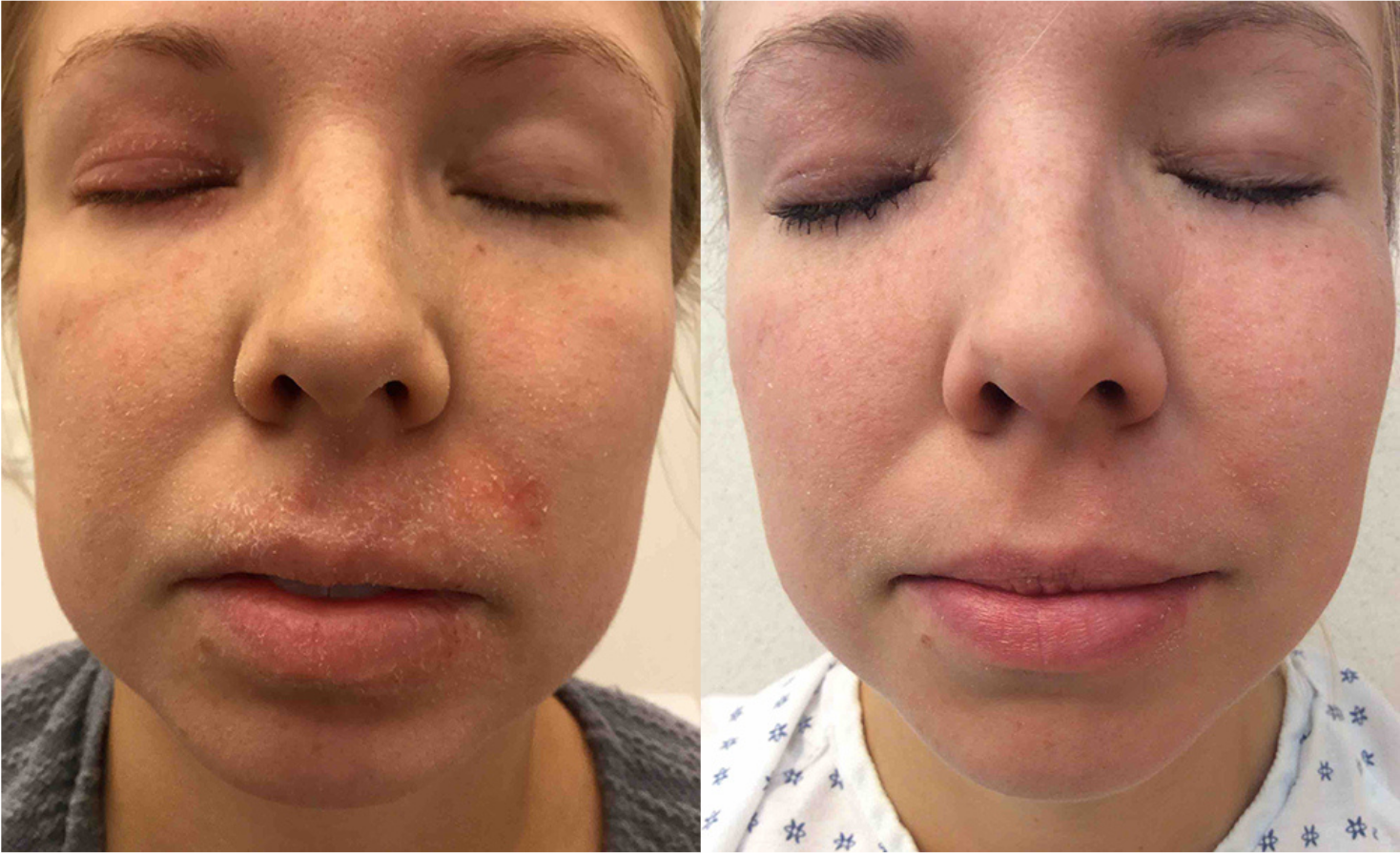 Before and after of A 29-year-old Female patient treated with the FixMySkin Healing Balm with 1% Hydrocortisone to improve the appearance of Eczema located on the mouth and upper lip areas, results; Post One Month Use.