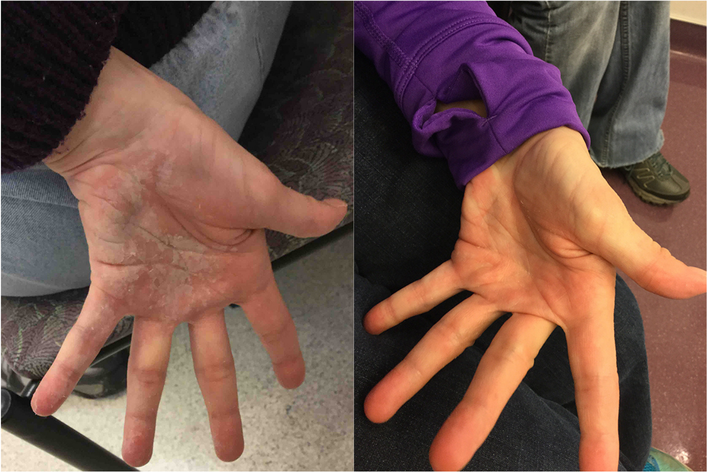 Before and after of a Female patient treated with the FixMySkin Healing Balm with 1% Hydrocortisone to improve the appearance of Eczema located on the inside of hands, results; Post One Month Use.