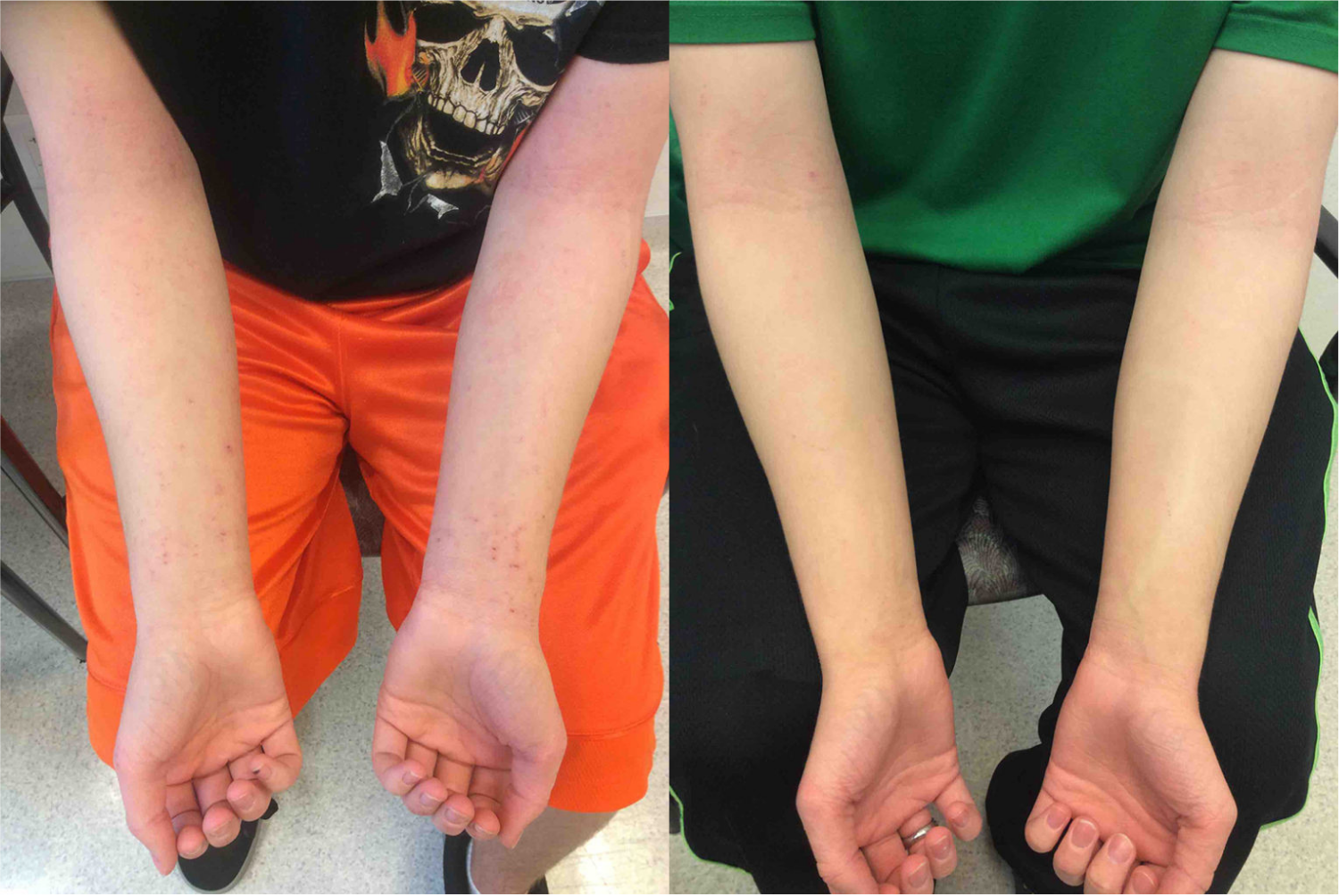 Before and after of a Male patient treated with the FixMySkin Healing Balm with 1% Hydrocortisone to improve the appearance of Eczema located on the inner elbows, results; Post One Month Use.