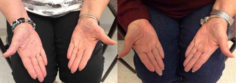 Before and after of a female patient treated with the Excimer Laser to improve the appearance of Psoriasis; results achieved post 38 treatments.
