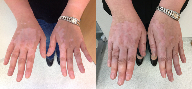 Before and after of a Female patient treated with the Excimer Laser to improve the appearance of vitiligo and reduce discoloration on hands.