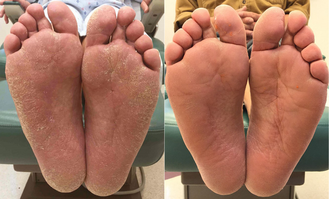 Before and after of a Male patient treated for Foot Fungus, results; Three Months Post Treatment.