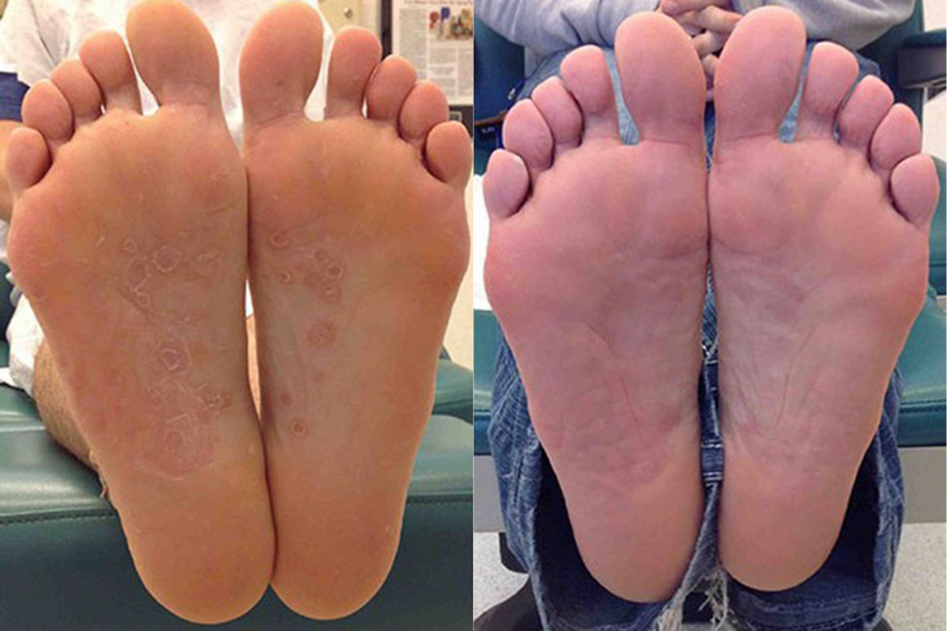 Before and after of a Male patient treated for Foot Fungus, results; Three Months Post Treatment.