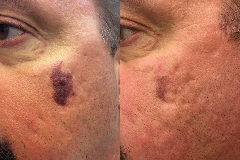 Before and after of a 47-year-old Male treated with two sessions of IPL Laser to reduce the appearance and discoloration of a Port Wine Stain.
