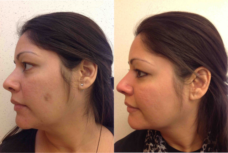 Before and after of a 37-year-old Female patient treated with IPL Laser for Lentigo to reduce the appearance of discoloration.
