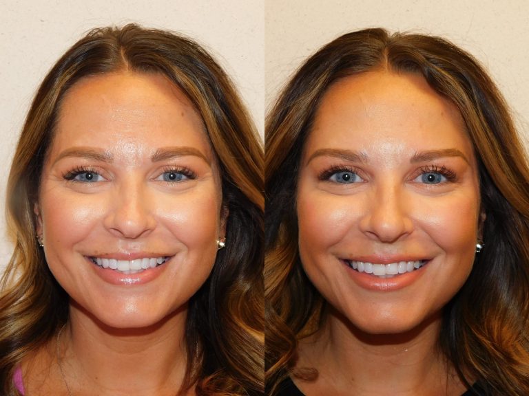 Before and after of a 34-year-old Female patient treated with Jeuveau.