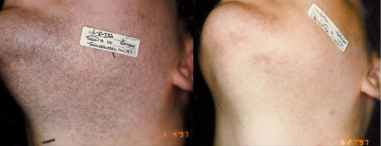 Before and after of a Female patient treated with Laser Hair Removal