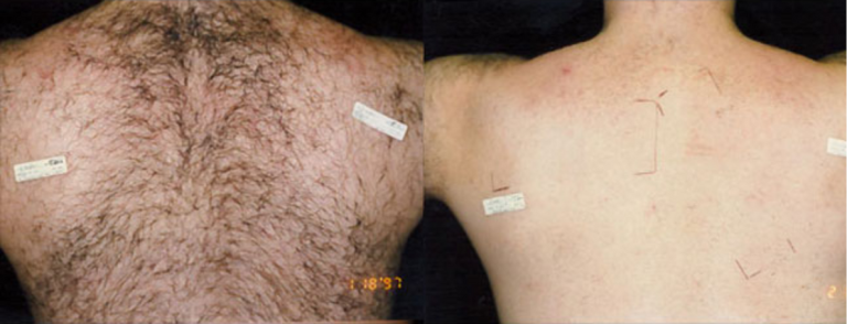 Before and after of a Male patient treated with Laser Hair Removal