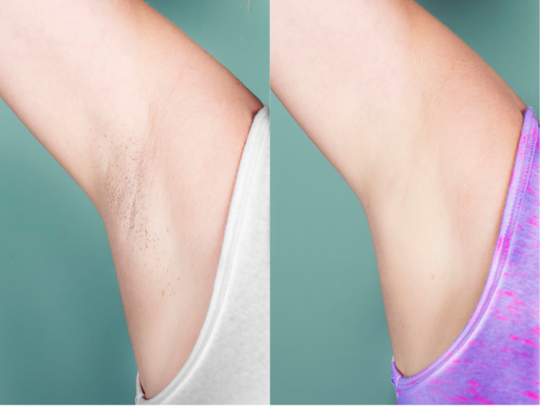 Before and after of a 28-year-old Female patient treated with Laser Hair Removal for underarm hair