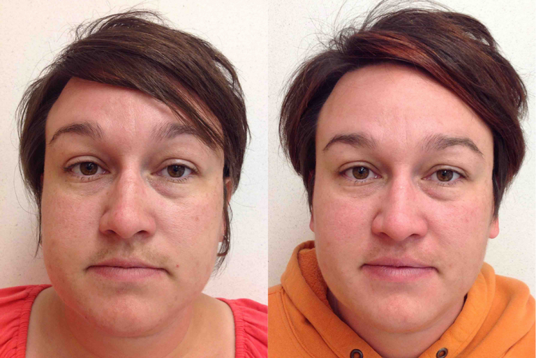 Before and after of a 34-year-old Female patient treated with Laser Hair Removal on upper lip hair