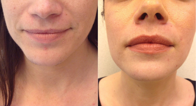 Before and after of a 32-year-old Female patient treated with Laser Hair Removal on chin