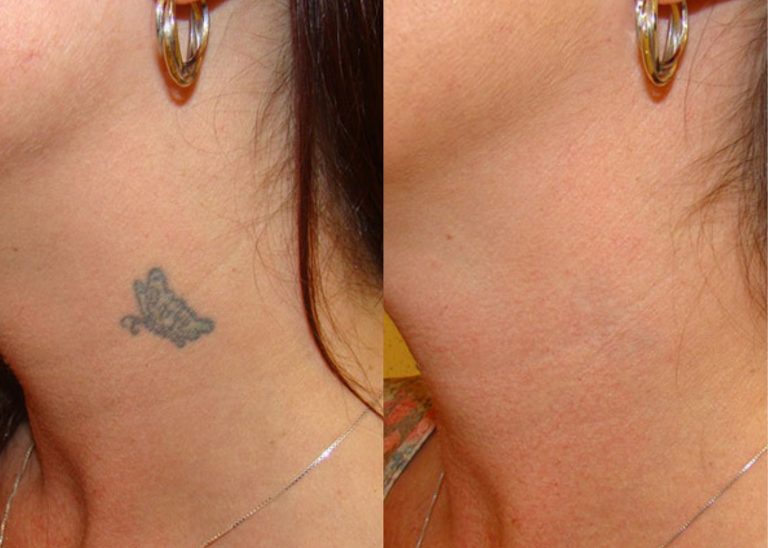 Before and after of a Female patient treated with Laser Tattoo Removal on neck