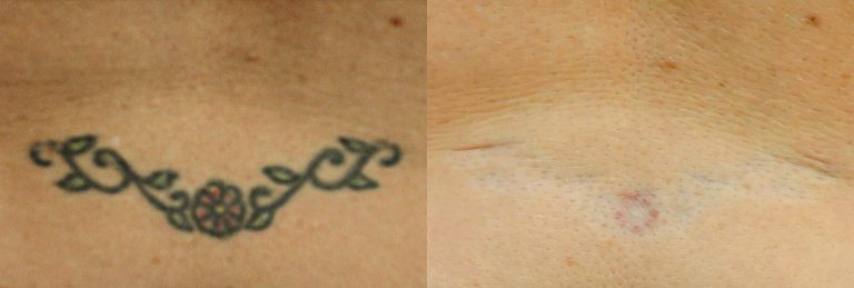 Before and after of a Female patient treated with Laser Tattoo Removal on lower back.