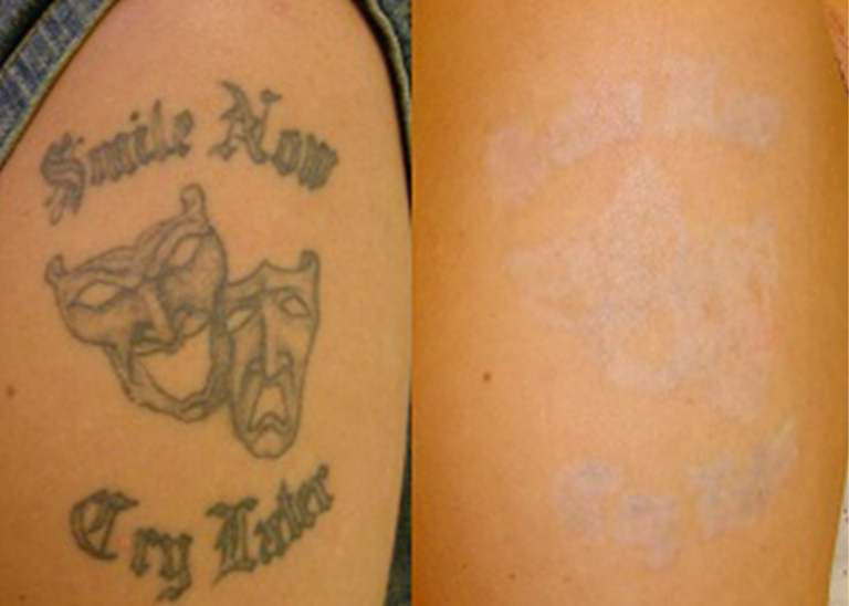 Before and after of a Male patient treated with Laser Tattoo Removal on  arm