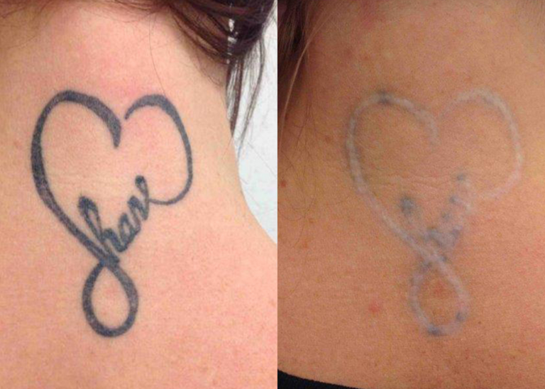 Before and after of a Female patient treated with Laser Tattoo Removal on nape of neck