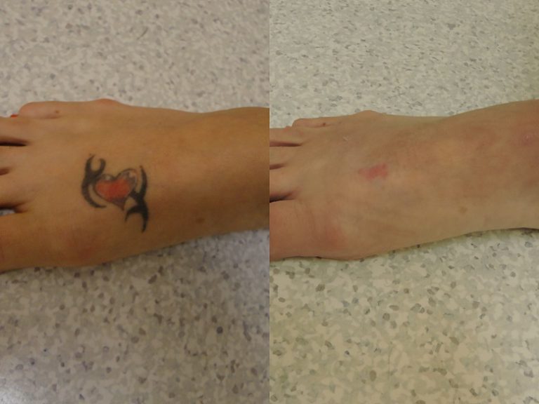 Before and after of a Female patient treated with Laser Tattoo Removal on top of foot.