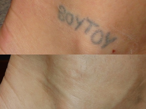 Before and after of a Female patient treated with Laser Tattoo Removal on ankle