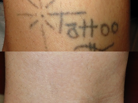 Before and after of a Female patient treated with Laser Tattoo Removal on ankle